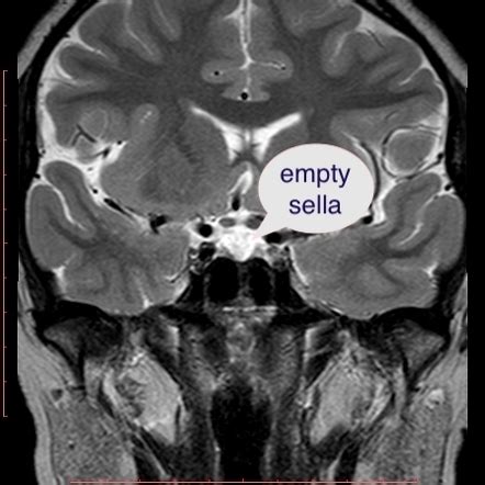 pituitary stalk interruption syndrome|panhypopituitarism in adults.